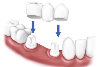 Dental Bridge