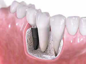 Dental Implant Restoration