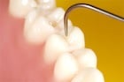 White Dental Fillings