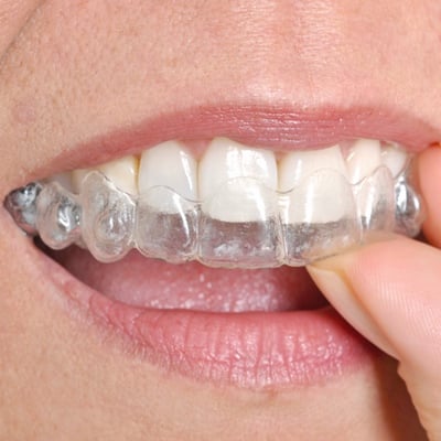 Invisalign for Kids and Adults in Chino