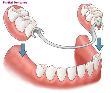 Partical Dentures Available at Silver Smile Dental