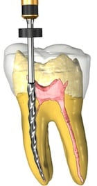 Root Canal Treatments