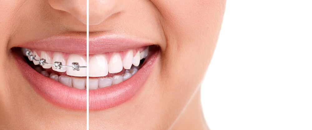 Are Dental Braces better than Invisalign?