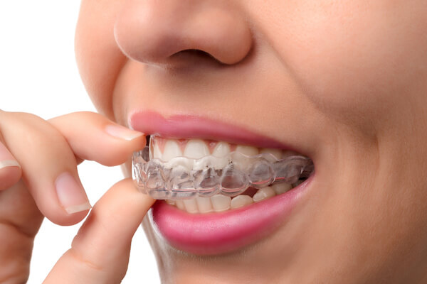 Trident Smiles Dental  Invisalign Aligners vs. Braces: Which is better for  your smile?