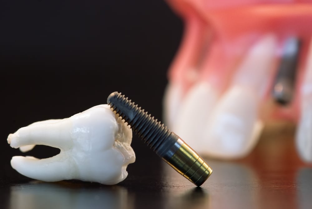 Why A Dental Implant Is Preferred Over A Bridge