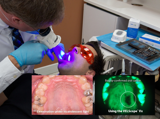 VELscope Oral Cancer Screening