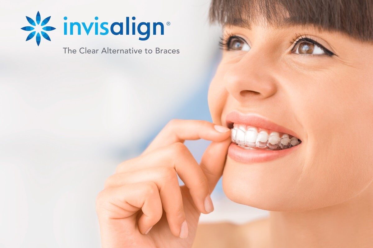 How Does Invisalign Work? Here’s a Complete Guide