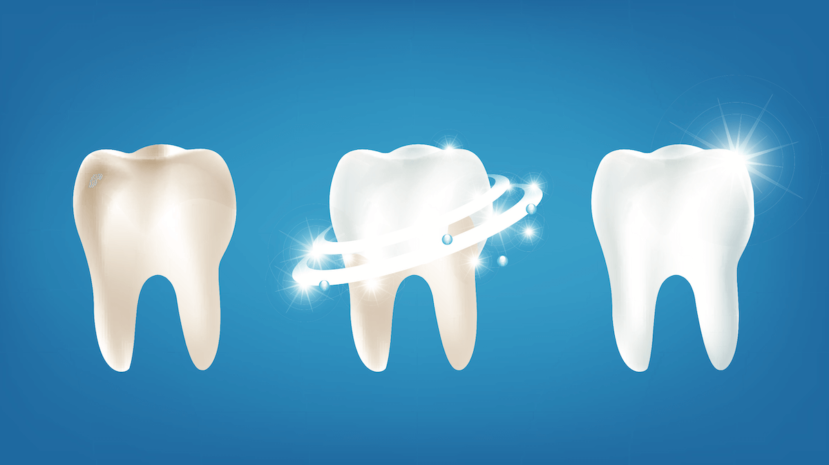 The Best Teeth Whitening Methods Your Dentist Offers