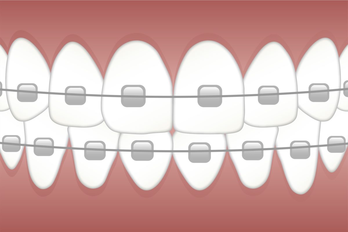 3 Fun Facts About Braces That’ll Leave a Smile on Your Face