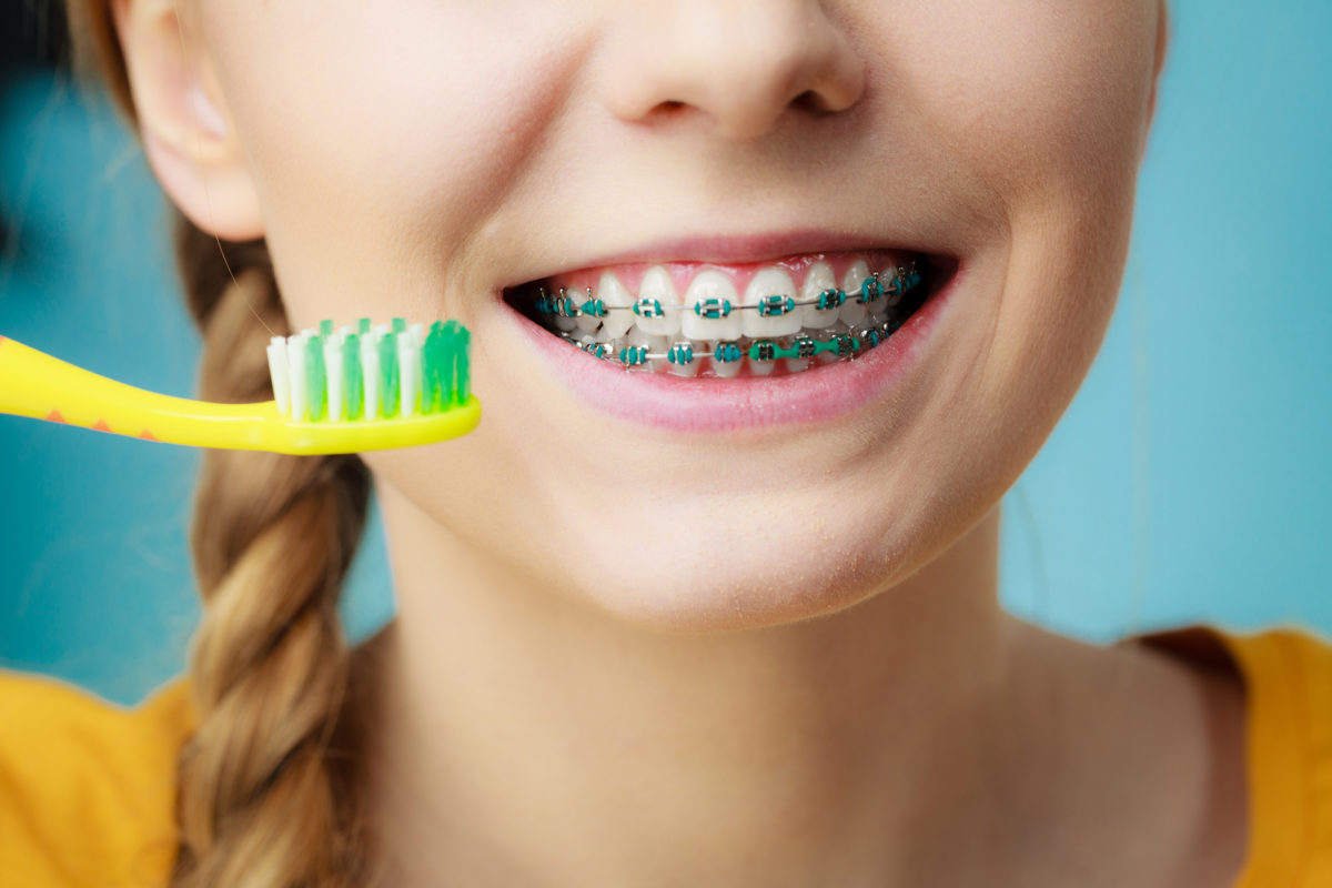 How to Keep Your Braces Clean: This is Everything You Need to Do